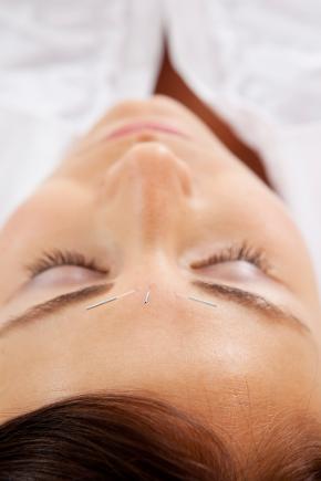 A facial acupuncture treatment